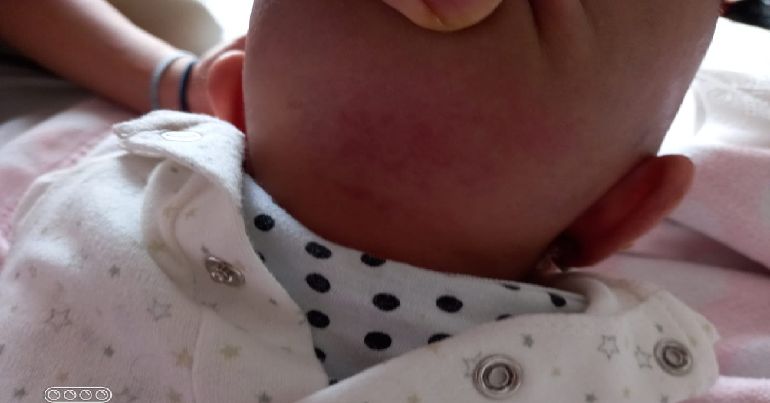 A baby with a skin irritation caused by bed bugs